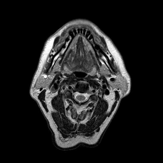 An MRI scan of a brain.